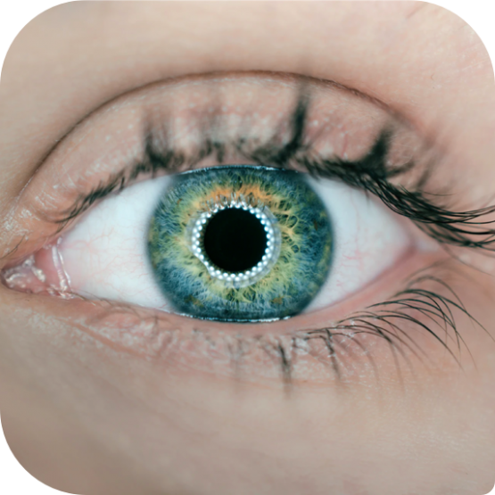 Glaucoma (High Eye Pressure)